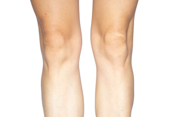 Women's legs with a scar on her knees on a white background, photo without retouching, close up of the girl's legs