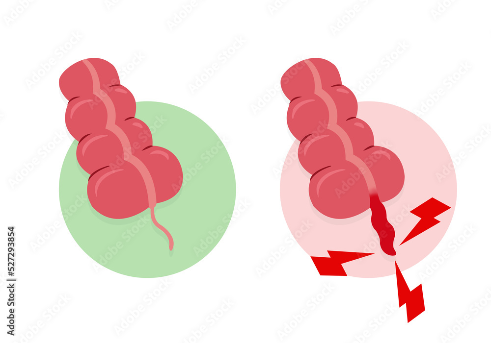 Comparison between an inflamed appendix and a normal appendix without ...