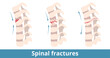 Spinal fractures. Types of spinal fractures depend on damage direction. Fracture of the vertebrae (backbone) caused from injury, trauma, fall, sports or some sort of high velocity impact.
