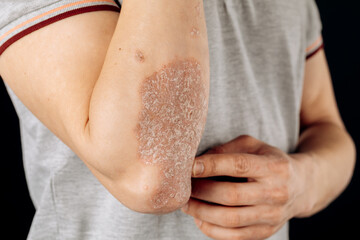 Wall Mural - Acute psoriasis on the elbows is an autoimmune incurable dermatological skin disease. A large red, inflamed, flaky rash on the elbows. Joints affected by psoriatic arthritis