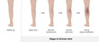 Stage of varicose veins. Varicose veins in the human leg vector.