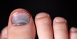 Close-up bruised nail of the big toe. Violet toenail. Injured foot.
