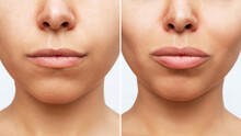 Result Of Lip Augmentation. Cropped Shot Of Young Woman's Lower Part Of Face With Lips Before And After Lip Enhancement On A White Background. Injection Of Filler In Lips