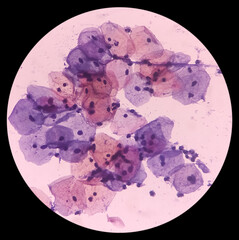 Wall Mural - Abnormal squamous epithelial cells view in microscopy.HPV criteria for pap smear slide cytology. Medical concept.