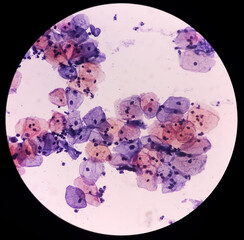 Poster - Abnormal squamous epithelial cells view in microscopy.HPV criteria for pap smear slide cytology. Medical concept.