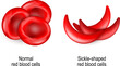normal erythrocytes and sickle-shaped red blood cells.