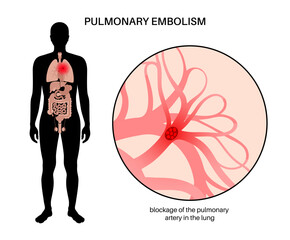 Sticker - Pulmonary embolism disease