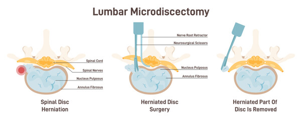 Lumbar microdiscectomy. Spinal disc herniation surgery. Removing