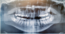 X Ray Image Of Wisdom Tooth Develops In A Sac Within The Lower Jawbone On Both Sides. Surgery, Dentist And Pain Concept.
