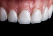 © Garo - dental job photography, crowns veneers implants