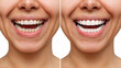 © Марина Демешко - Cropped shot of a young caucasian smiling woman before and after veneers  installation isolated on a white background. Teeth whitening. Dentistry, dental treatment