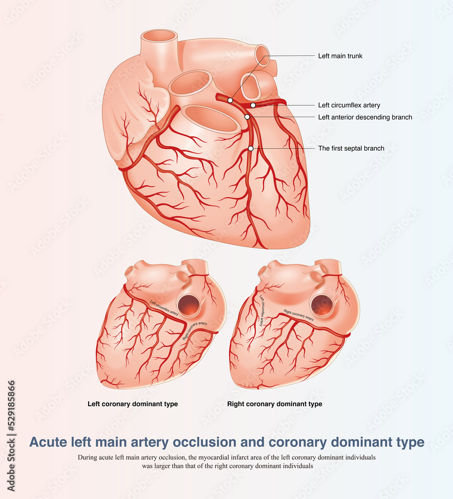 In acute left main artery occlusion, the myocardial infarct area of ...