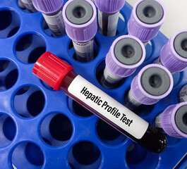 Poster - Blood sample for Hepatic profile test, liver(hepatic) function panel.