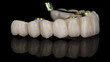 side view of a dental prosthesis of the upper jaw with a gilded beam on black glass with reflection