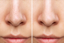 Close-up Of Woman's Nose With Blackheads Before And After Peeling, Cleansing The Face Isolated On A White Background. Acne Problem, Comedones. The Result Of Getting Rid Of Black Dots