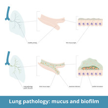 Common Lung Pathology And Excessive Mucus. Diseases (cystic Fibrosis) May Cause The Formation Of Thick Mucus In Airways, Bacterial Infection. Biofilm Formation In The Lungs.