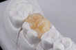 Dental ceramic Inlay