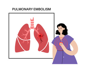 Poster - Pulmonary embolism disease