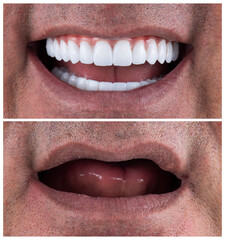 Wall Mural - dental job photography, crowns veneers implants