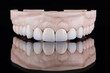 Quality dental prosthesis made of titanium beam and ceramics for fixation to the upper jaw. Teeth treatment.