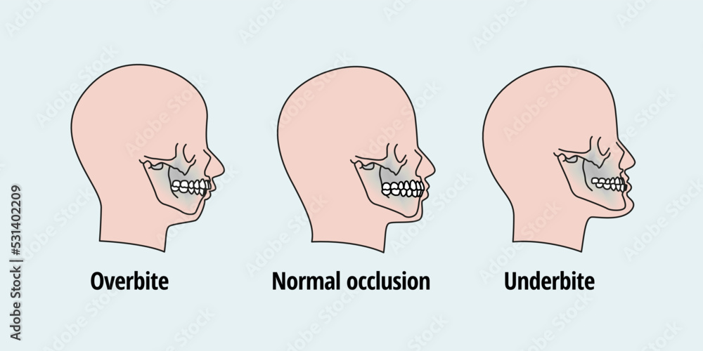 Tooth Problem Side View Man With Misaligned Teeth Malocclusion Stock tooth-problem-side-view-man-with-misaligned-teeth-malocclusion-stock