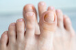 person feet close up, fungus, broken nail, skin infection, toe mycosis, treatment needed, fungal infection concept, onychomycosis, onycholysis, nail separates from nail bed, separated 