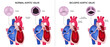 The difference of normal aortic valve and bicuspid aortic valve. Valvular aortic stenosis. Heart anatomy vector. Close-up of normal and abnormal aortic valves.