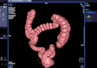 Sticker - CT colonography  3D rendering.