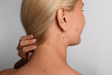 Woman With Birthmarks On Light Grey Background, Back View