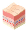 Skincare medical concept. Problems in cross-section of human skin horizontal layers structure. Anatomy illustrative model unhealthly layer of skin