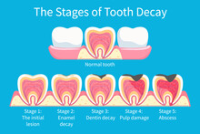 Stages Development Of Tooth Decay, Dental Plaque In Enamel And Dentin, Pulpitis And Periodontitis. Dental Infographic Poster Stages Tooth Decay, Medical Educational Caries Tooth.