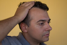 Image Of A Man Showing The Onset Of Hair Loss And The Principle Of Receding Hairline. Possible Causes And Remedies For Hair Loss
