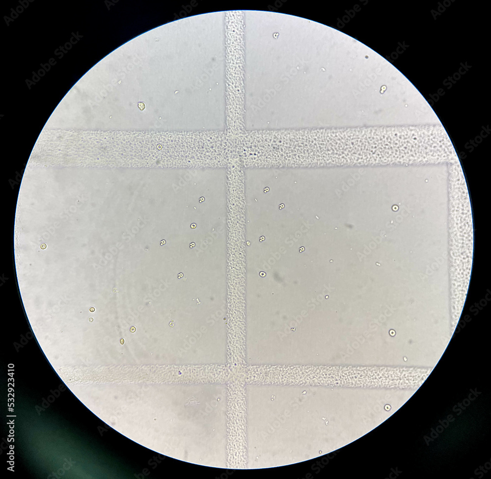 Dysmorphic urinary RBCs have been regarded as an indicator of ...