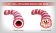 The illustration shows two parts of the bronchi, one normal and the other bronchitis and filled with sputum. use in medical and educational