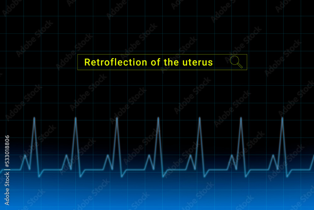Retroflection Example Retroflection of the uterus.Retroflection of the uterus inscription in ...