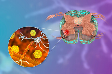 Sticker - Polio viruses affecting motor neurons