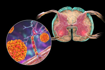 Sticker - Polio viruses affecting motor neurons