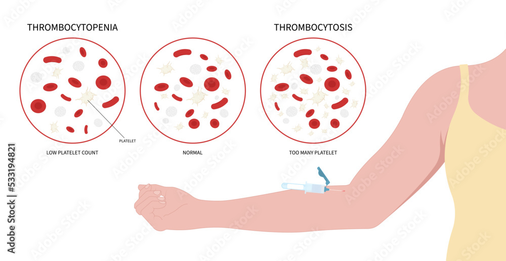 Image vectorielle Stock low platelet count and hematuria Decreased ...