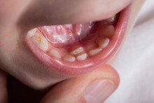 A Permanent Molar In A Child Grows Second Row. Incorrect Growth Of Molars Or Polyodontia In Dentistry, Close-up