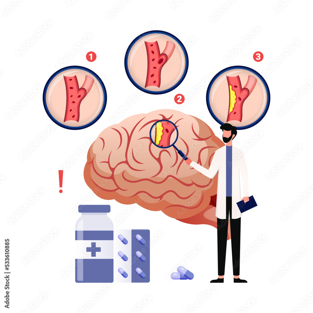World Stroke day banner, mnemonic. Brain and human face vector. の Stock ...