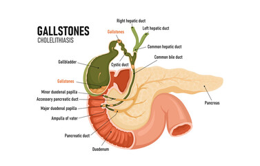 Wall Mural - Cholelithiasis, cholecystitis. Formations in the gallbladder. Blockage of the bile duct. Pancreas.