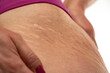 Close-up of a female thigh with white and dark stretch marks from a sharp weight loss or weight gain isolated on a white background