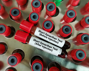 Canvas Print - Bloods sample for short Synacthen test. Before injection and after injection. ACTH Stimulation test.