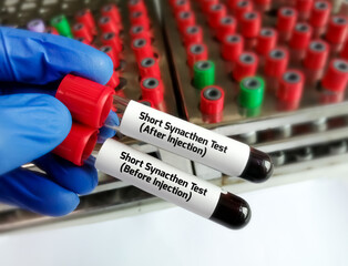 Canvas Print - Bloods sample for short Synacthen test. Before injection and after injection. ACTH Stimulation test.