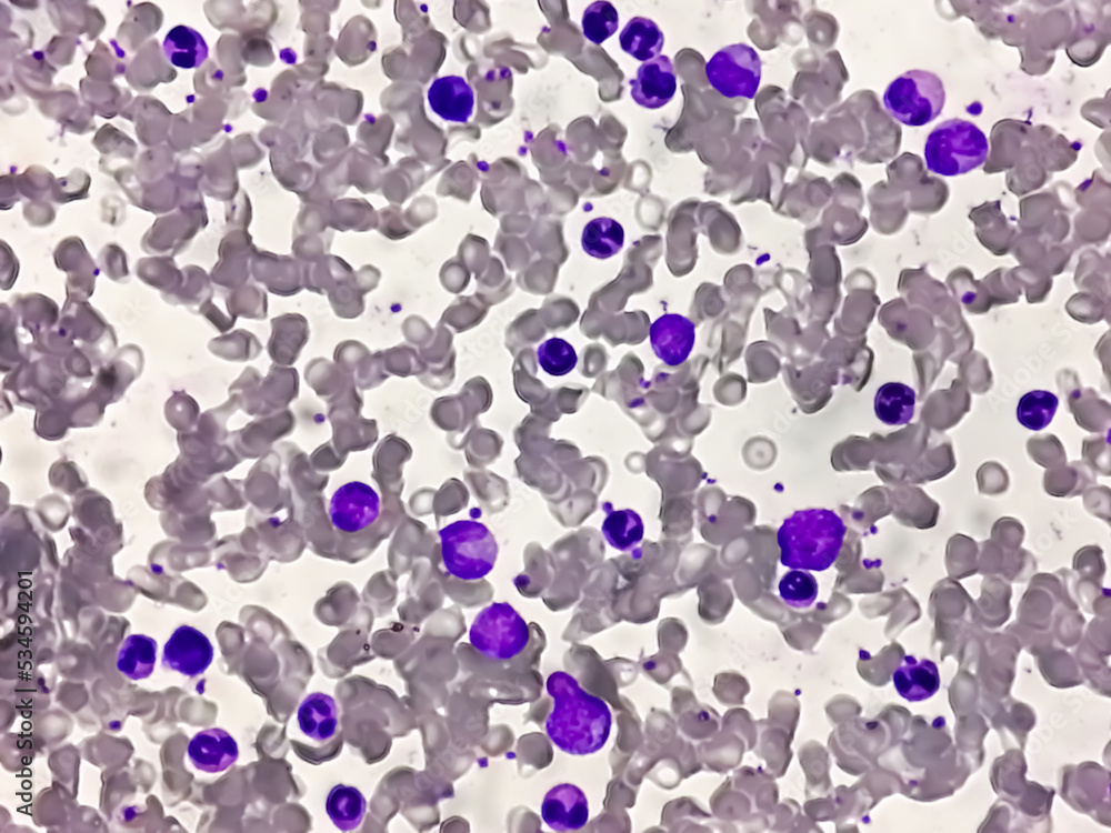 Chronic myelogenous leukemia (CML), also known as chronic myeloid ...
