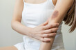 © KMPZZZ - Close up of stain bruise wound on her arm, contusion asian young woman, girl an accident fell down stairs at home, hand in healing injury by massage hematoma blood. Extravasation blue, purple on skin.
