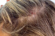 © SNAB - Psoriasis of the scalp , psoriatic redness, peeling and crusts on the scalp of an unrecognizable woman. An autoimmune, incurable dermatological skin disease.