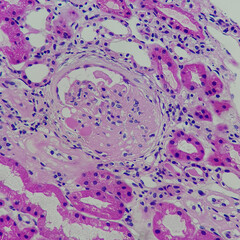 Poster - Camera photo of focal segmental glomerulosclerosis, showing segmental obliteration of capillary lumen, magnification 400x, HE stain