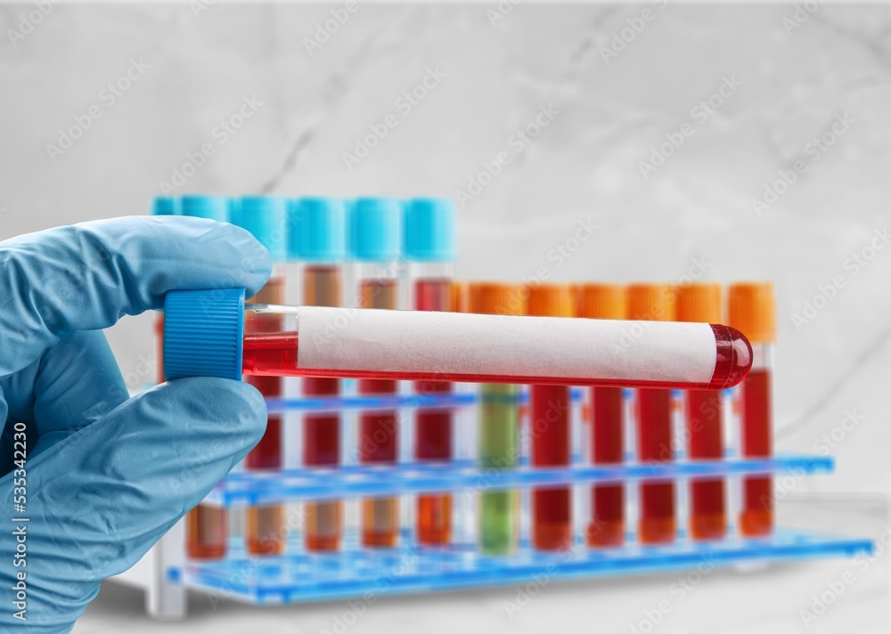 Blood sample tube for Monkeypox virus test. stranded DNA, zoonotic ...
