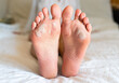 © Markoff - Problems with the skin of the feet. Dermatological diseases. Close-up.